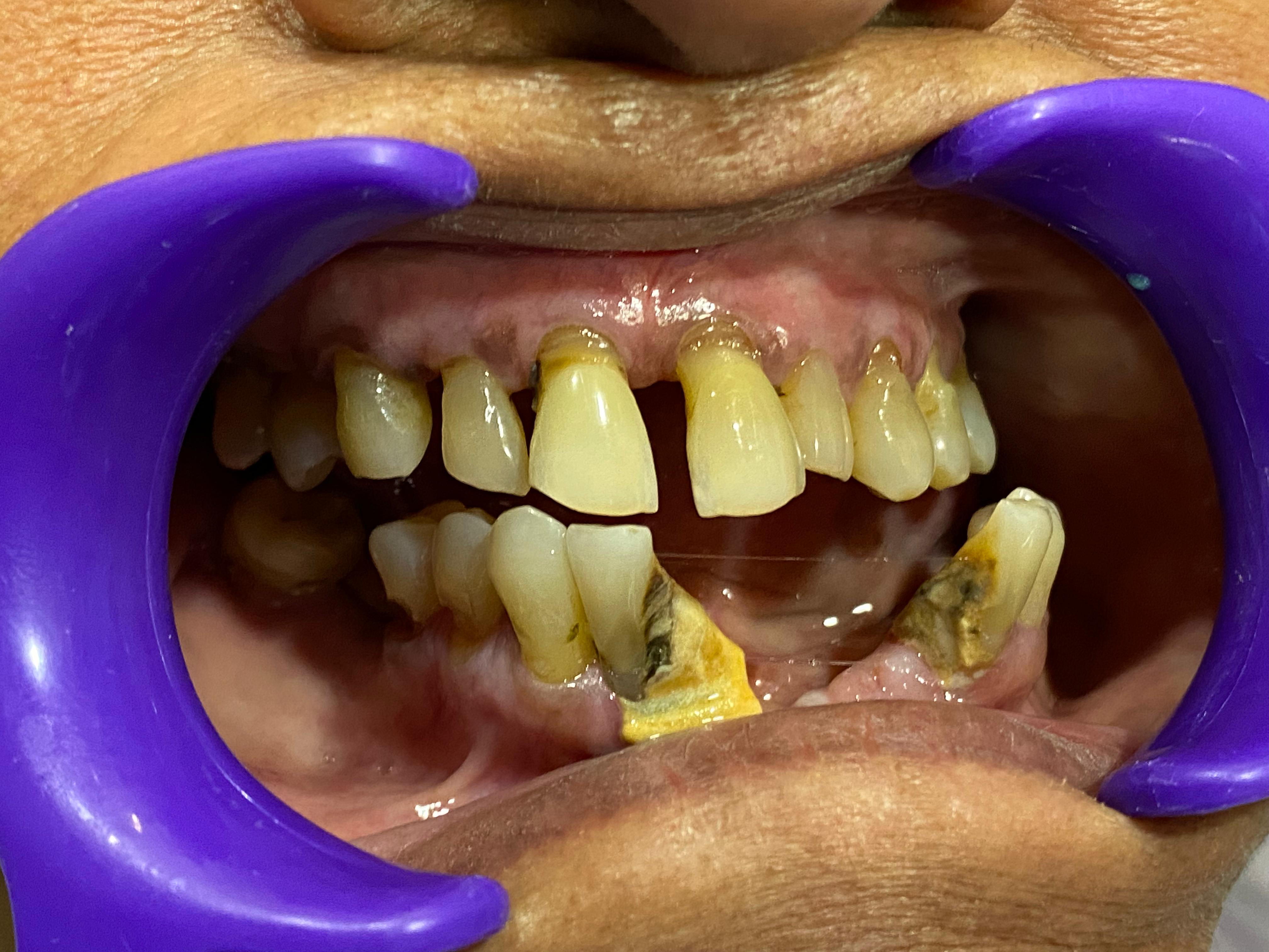 Before Treatment
